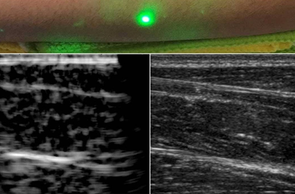 全球首张人类激光超声波图像问世